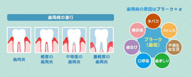歯周病の進行について　歯肉炎から軽度の歯周炎になり、中等度、重度へと進んでいきます。歯周病の原因はプラ－ク＋αです。